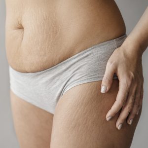 Scars & Stretch Marks Treatment with TropoCollagen GUNA®