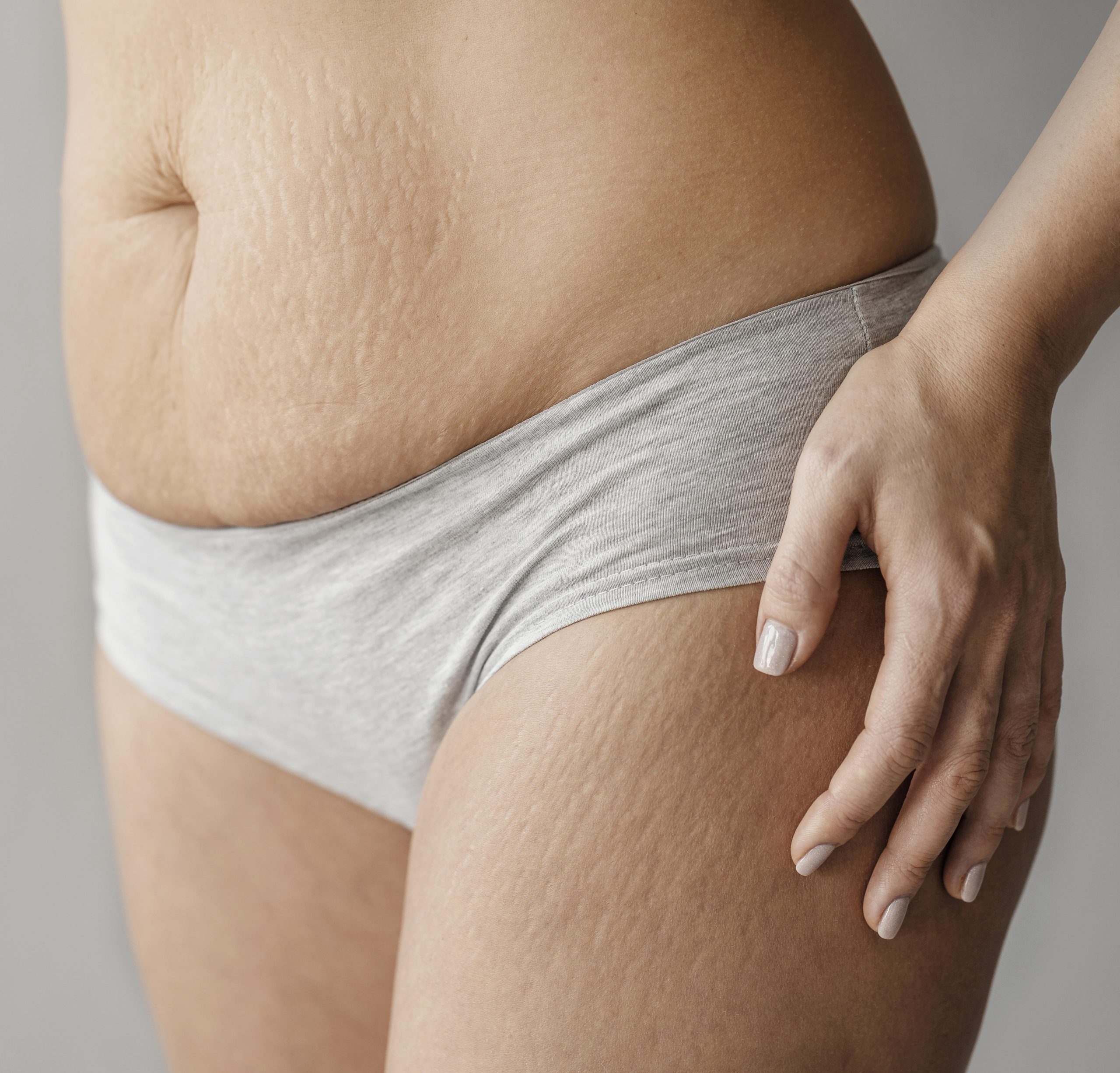 Scars & Stretch Marks Treatment with TropoCollagen GUNA®