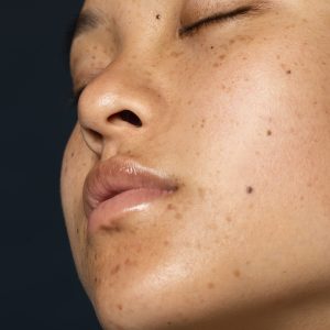 Cosmelan® Treatment