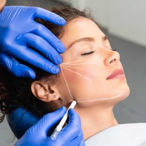 SCULPTRA® – COLLAGEN STIMULATING TREATMENT