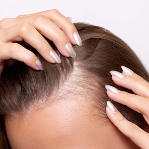 Hairloose Mesotherapy